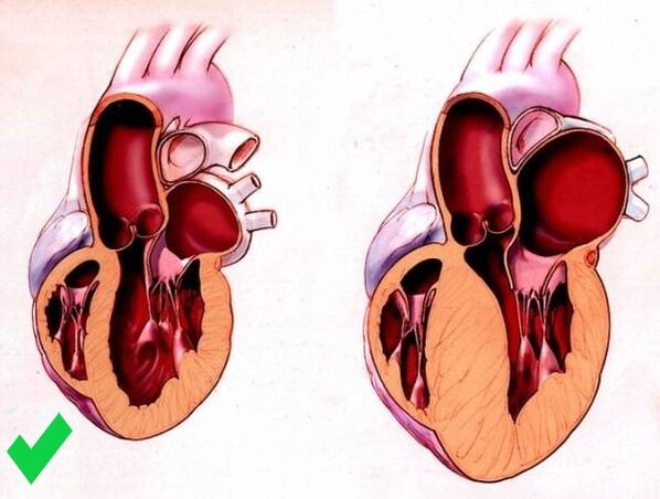 يمنع Cardione تضخم القلب البطيني